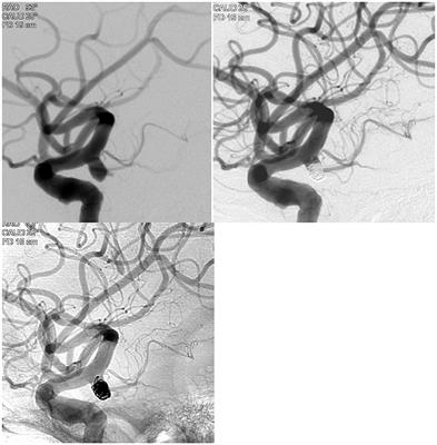 TARGET® Intracranial Aneurysm Coiling Prospective Multicenter Registry: Final Analysis of Peri-Procedural and Long-Term Safety and Efficacy Results